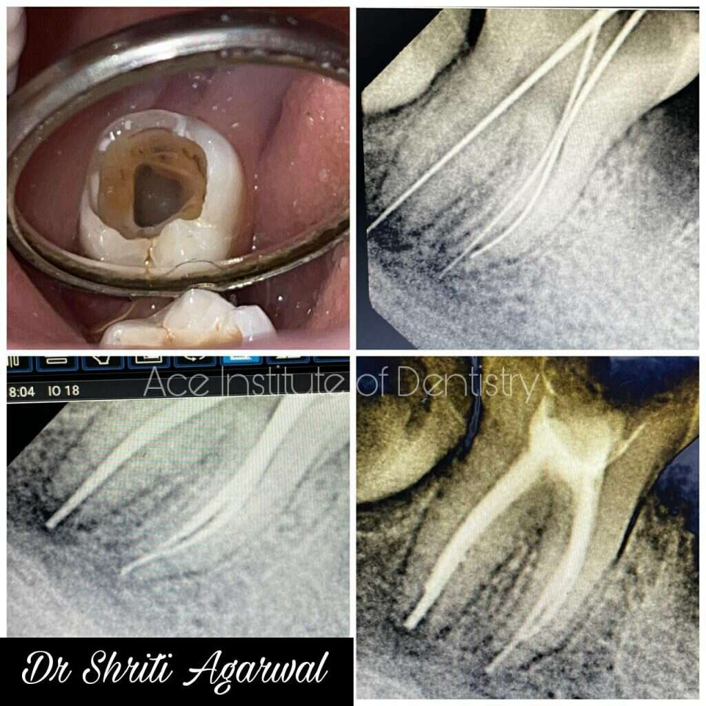 Single sitting rct done wrt 47

File used- glide files and fanta one file {25 6%}
Distal canal was wide
Mastercone used in distal canal 25 4&6%
And in mb and ml-25 6%